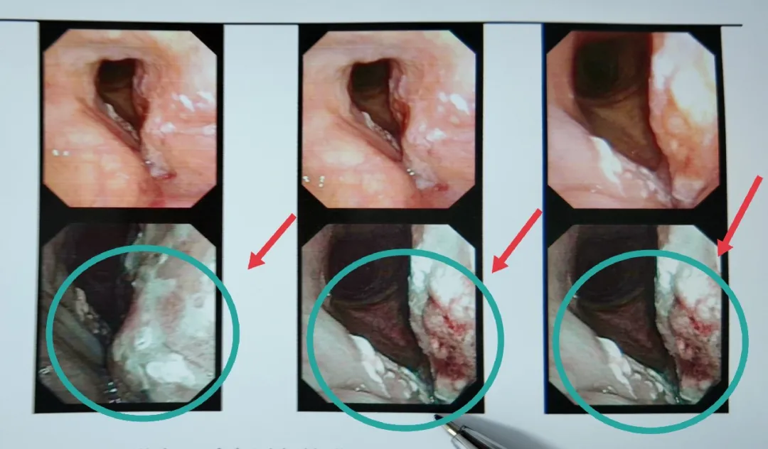 Endoscopic view of laryngeal lesion — preoperative and postoperative comparison at Xi'an Chang'an Hospital
