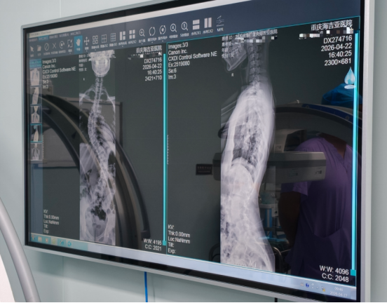Pre-operative X-ray imaging display at Chongqing HYGEIA Hospital showing detailed spinal curvature measurements