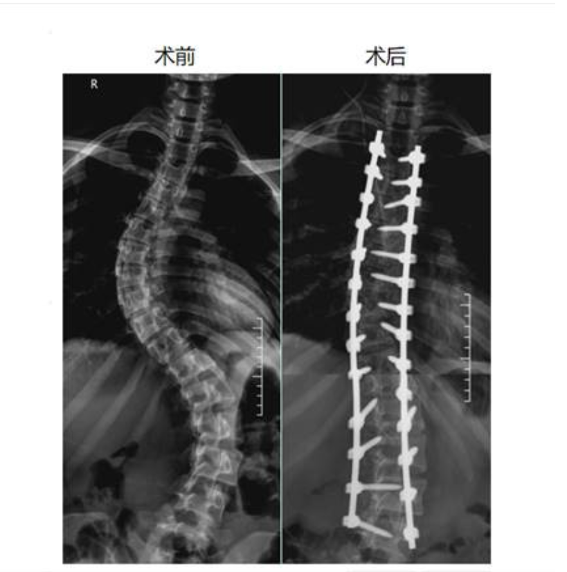 Before and after X-ray comparison showing dramatic scoliosis correction from 67 degrees to approximately 10 degrees