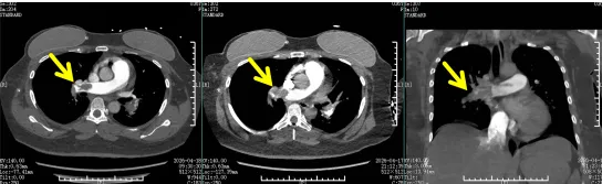 DSA fluoroscopy during mechanical aspiration thrombectomy — catheter navigating pulmonary arteries and extracting dark-red thrombus fragments at Chongqing HYGEIA Hospital