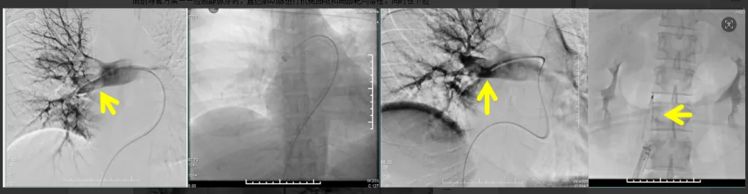 Post-procedural CT showing restored pulmonary arterial patency with significantly reduced thrombus burden after intervention at Chongqing HYGEIA Hospital