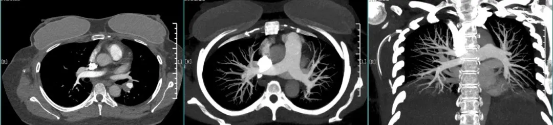 Interventional radiology team led by Dr. Gan Dengwei performing the emergency pulmonary embolism rescue procedure in the DSA catheterization laboratory at Chongqing HYGEIA Hospital