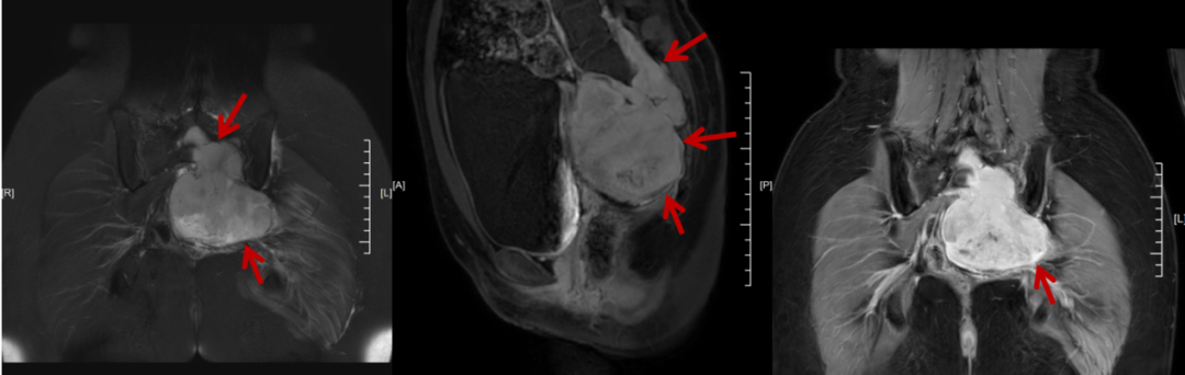 Pre-operative MRI showing sacral nerve malignant tumor in a 17-year-old patient at Chongqing HYGEIA Hospital