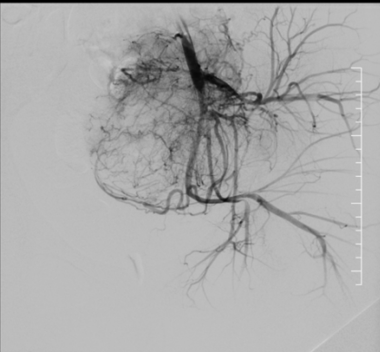Post-embolization DSA angiogram showing marked reduction in tumor vascularity after TACE procedure