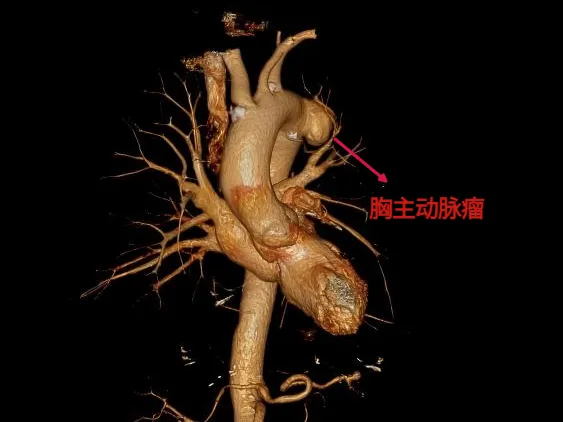 CTA 3D reconstruction showing thoracic aortic aneurysm at Suzhou Yongding Hospital