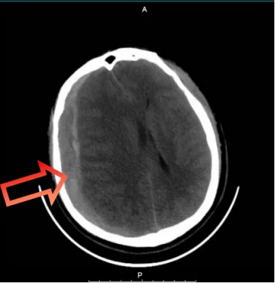 Pre-operative head CT showing massive right subdural hematoma with 19mm thickness and 14mm midline shift — dual brain herniation