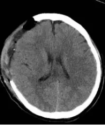 Post-operative CT showing complete hematoma evacuation and normalized brain structures after emergency craniotomy at Chongqing HYGEIA Hospital
